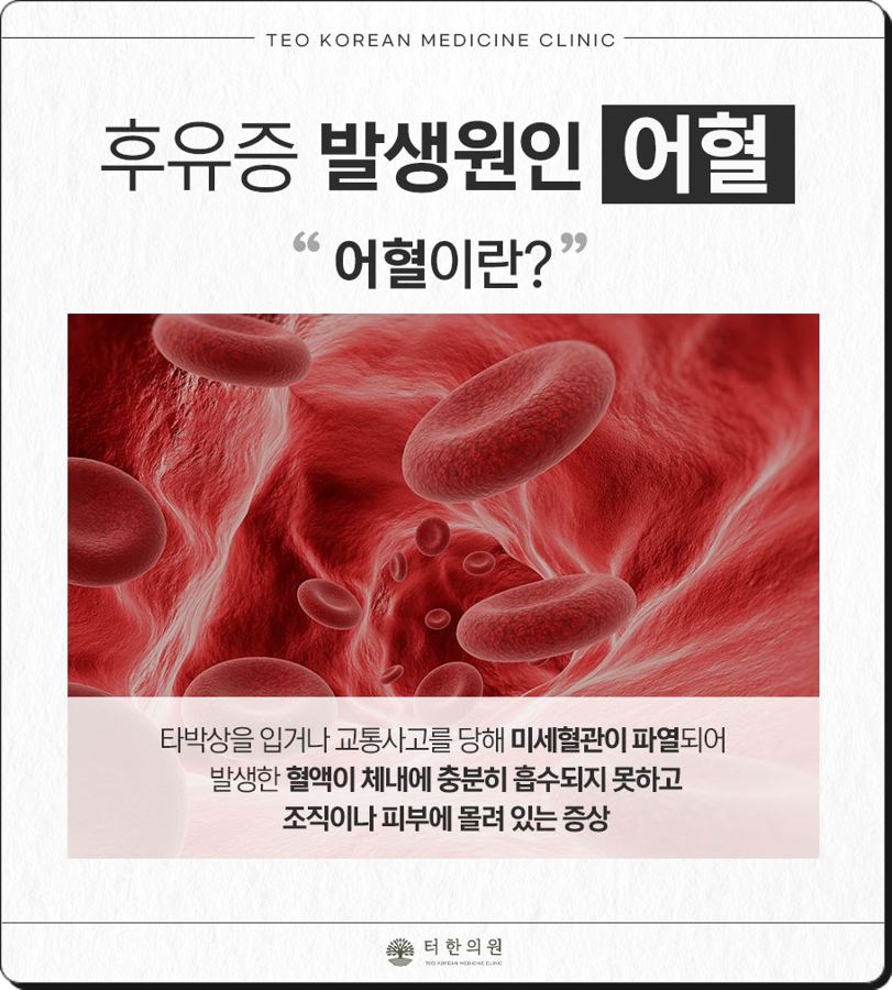 교통사고 후 생기는 어혈을 설명한 안내문