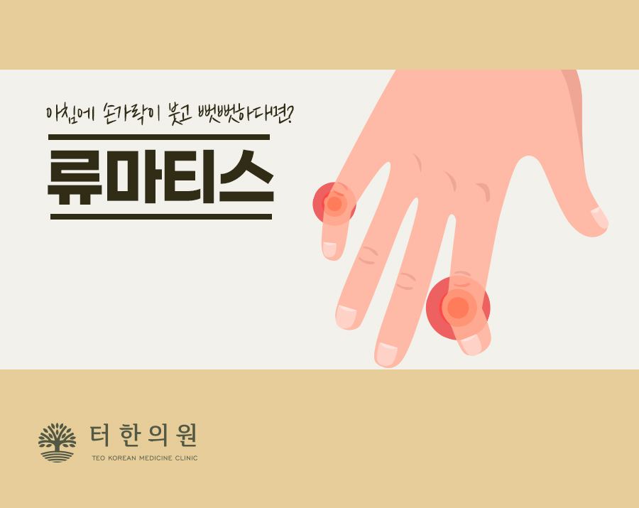 손가락 관절의 붉은 통증 부위를 표시한 류머티즘 안내 삽화